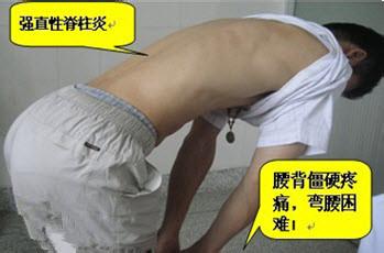 青少年强直性脊柱炎