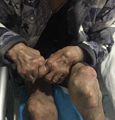 成都治痛风专业医院：痛风病的那些不为人知的危害!