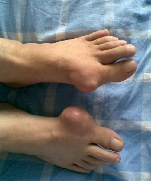 痛风石怎么消除?痛风石治疗方法