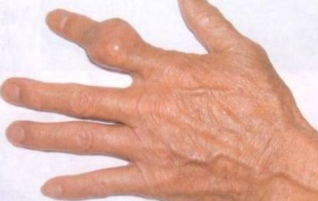 成都痛风专家：消除痛风石的3个好办法