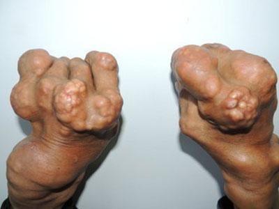 痛风石怎么办?如何预防痛风石的出现?