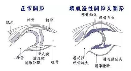 类风湿医院成都：什么是类风湿关节炎症状有哪些?