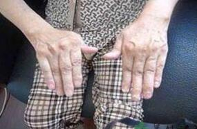成都风湿病医院在哪里？风湿性关节炎的发病原因?