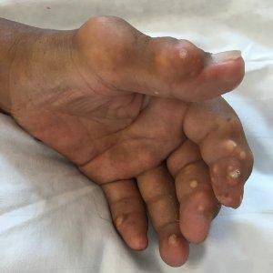 成都痛风治医院：痛风中医治疗方法